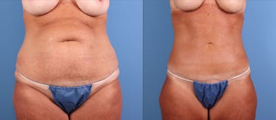 Abdomen Before & After Gallery - Patient 372813 - Image 1