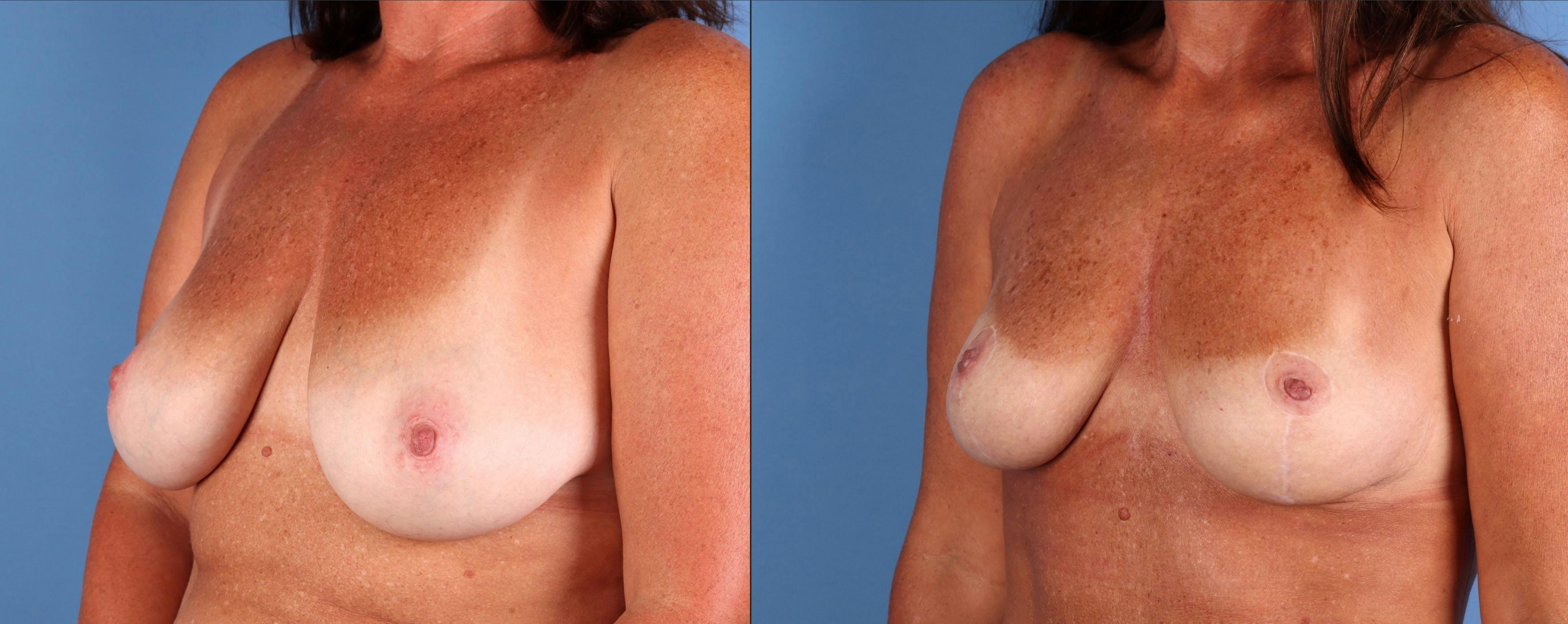 Breast Lift Before & After Gallery - Patient 220559 - Image 4
