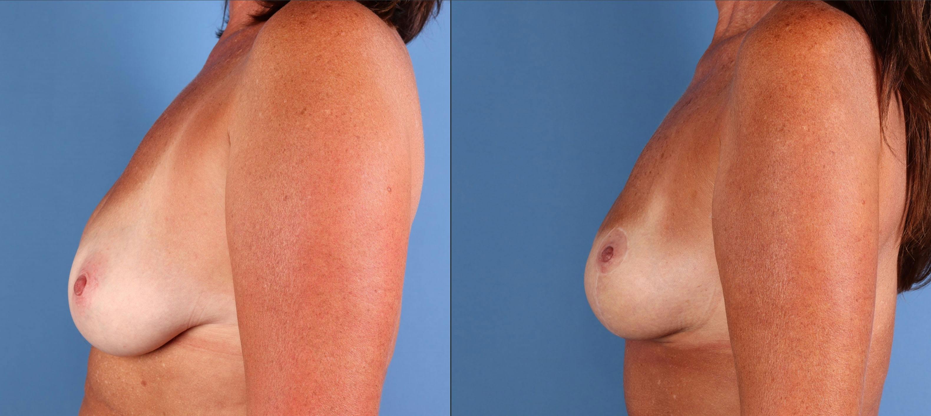 Breast Lift Before & After Gallery - Patient 220559 - Image 5