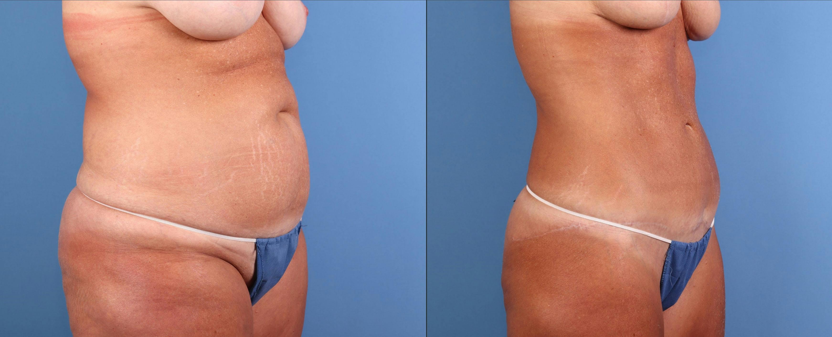 Abdomen Before & After Gallery - Patient 372813 - Image 2