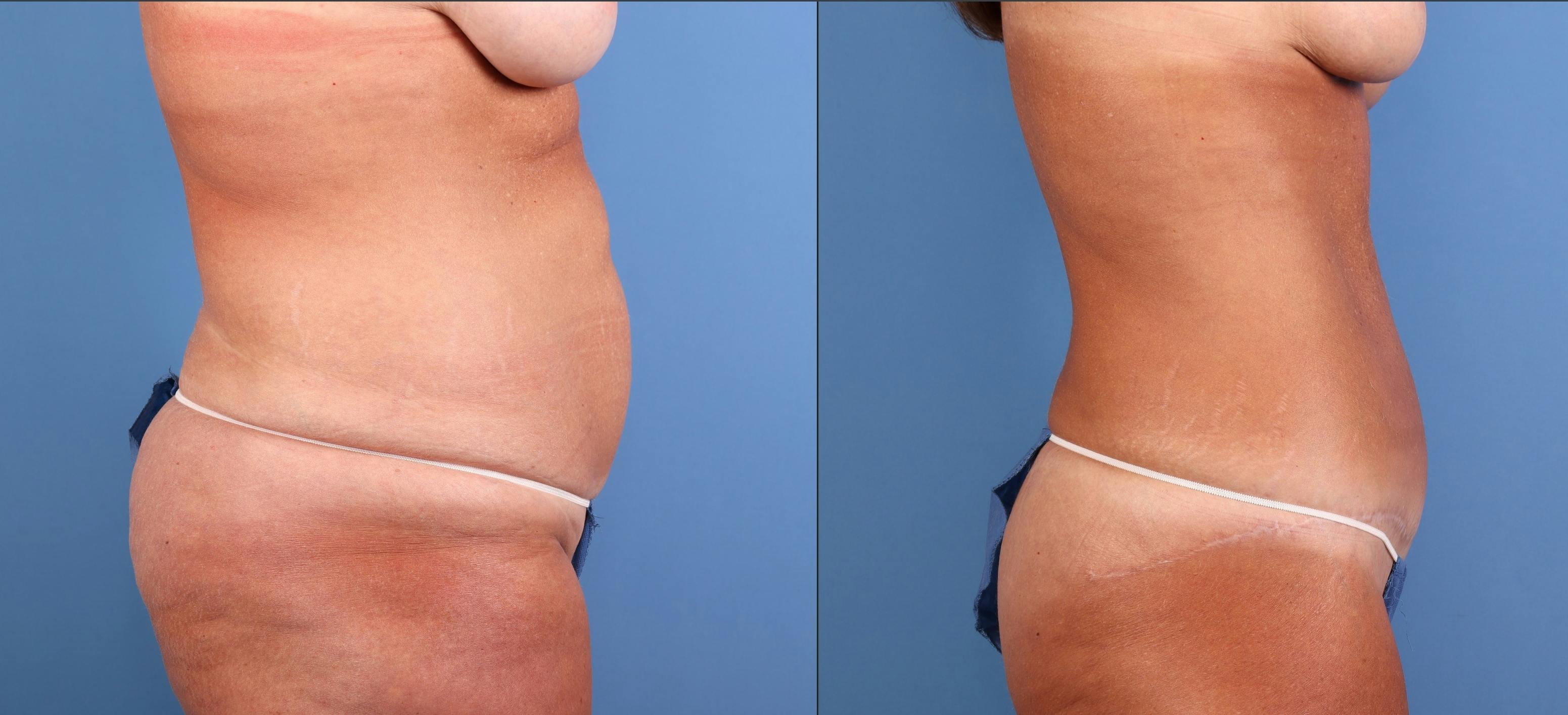 Abdomen Before & After Gallery - Patient 372813 - Image 3