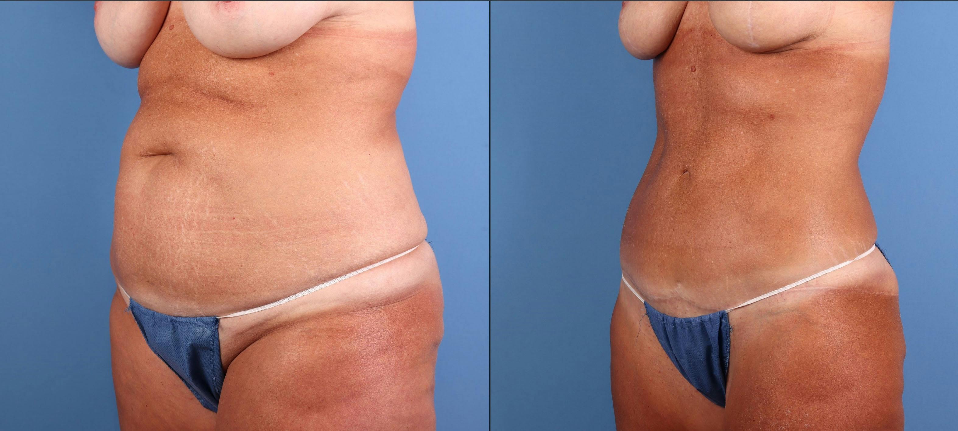 Abdomen Before & After Gallery - Patient 372813 - Image 4