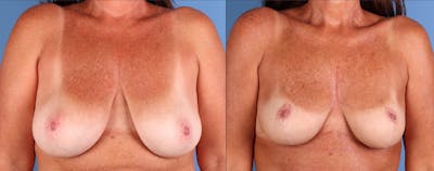 Breast Lift Before & After Gallery - Patient 220559 - Image 1