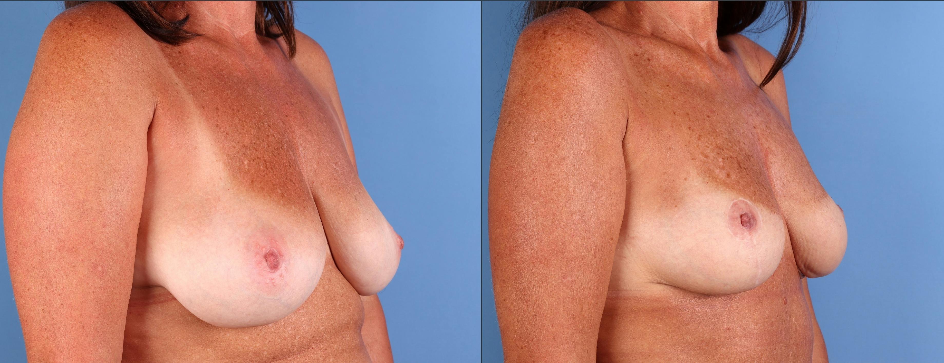 Breast Lift Before & After Gallery - Patient 220559 - Image 2
