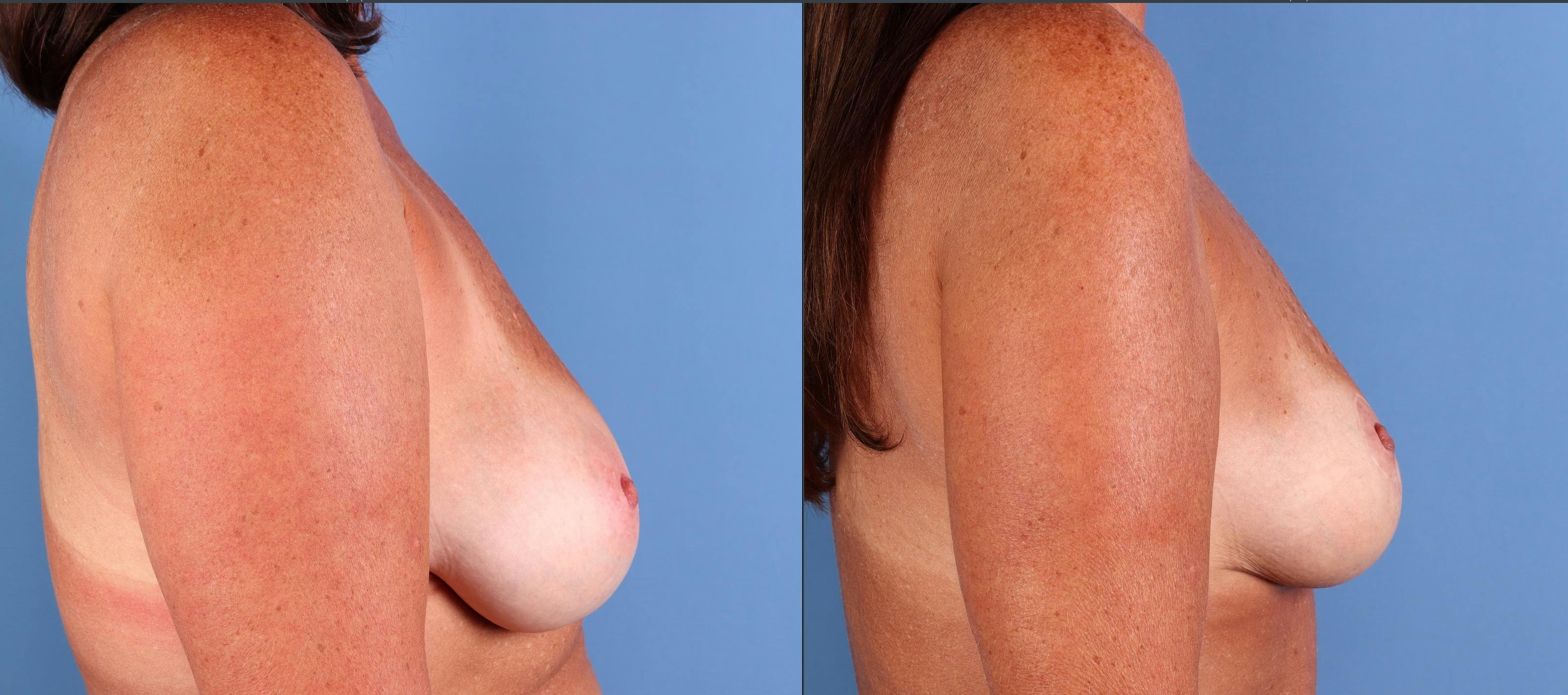 Breast Lift Before & After Gallery - Patient 220559 - Image 3
