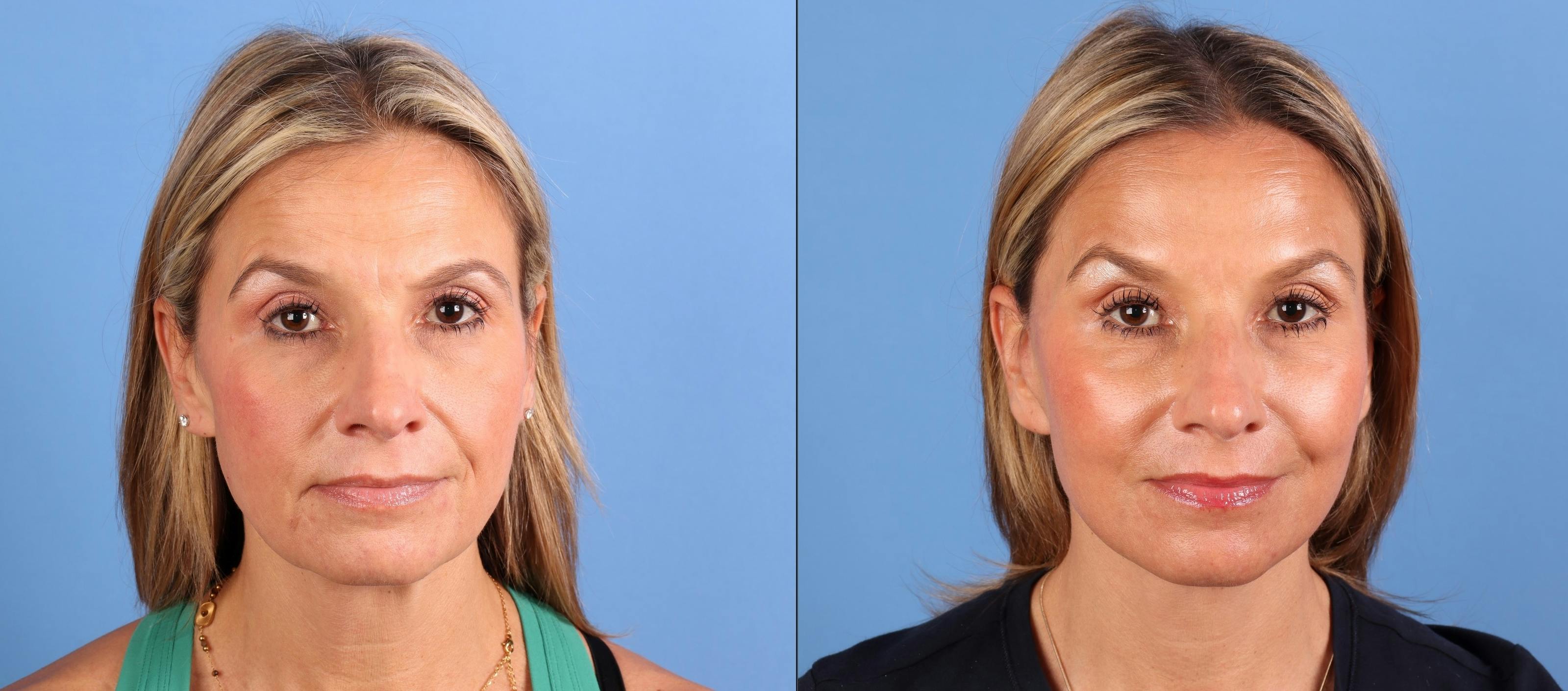 Facial Fillers Before & After Gallery - Patient 386281 - Image 1