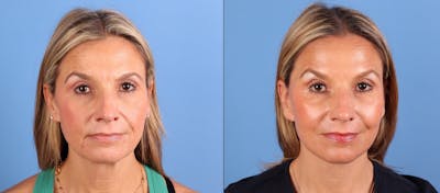 Laser Treatments Before & After Gallery - Patient 179878 - Image 1