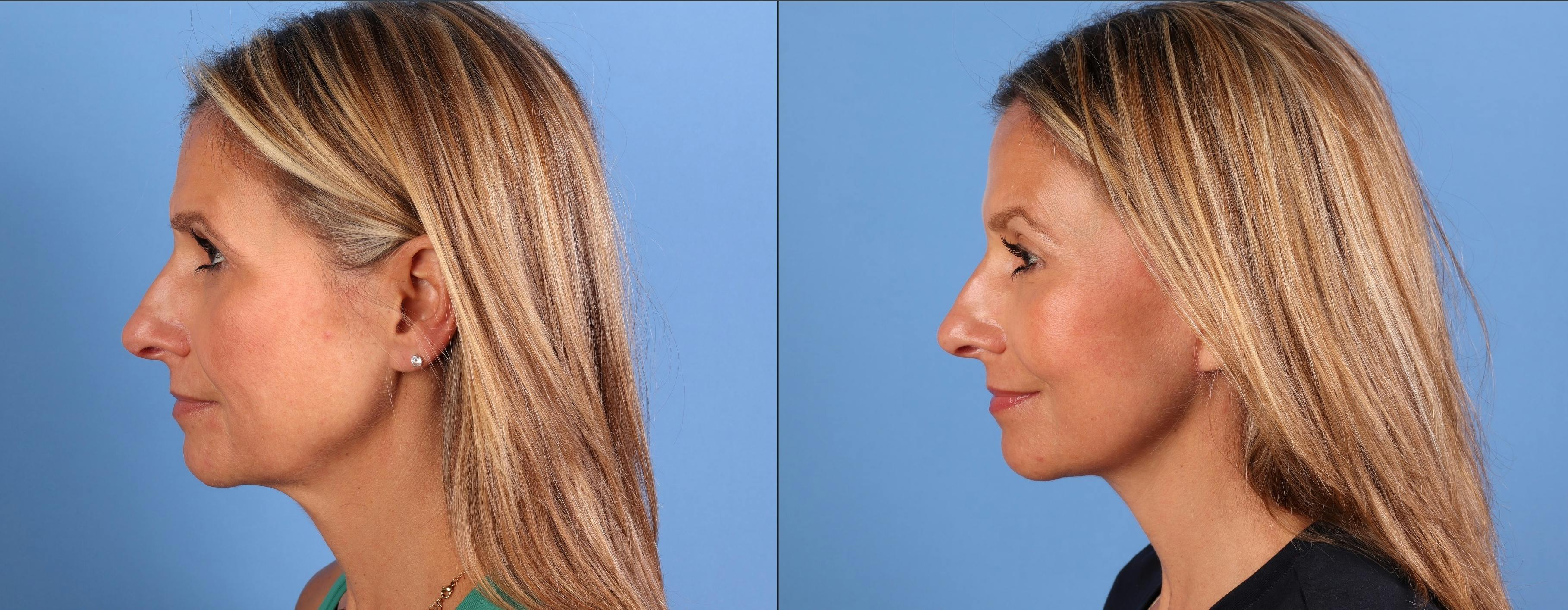 Facial Fillers Before & After Gallery - Patient 386281 - Image 5