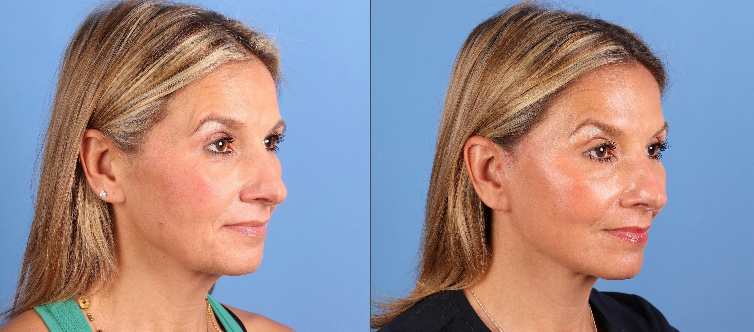 Facial Fillers Before & After Gallery - Patient 386281 - Image 2
