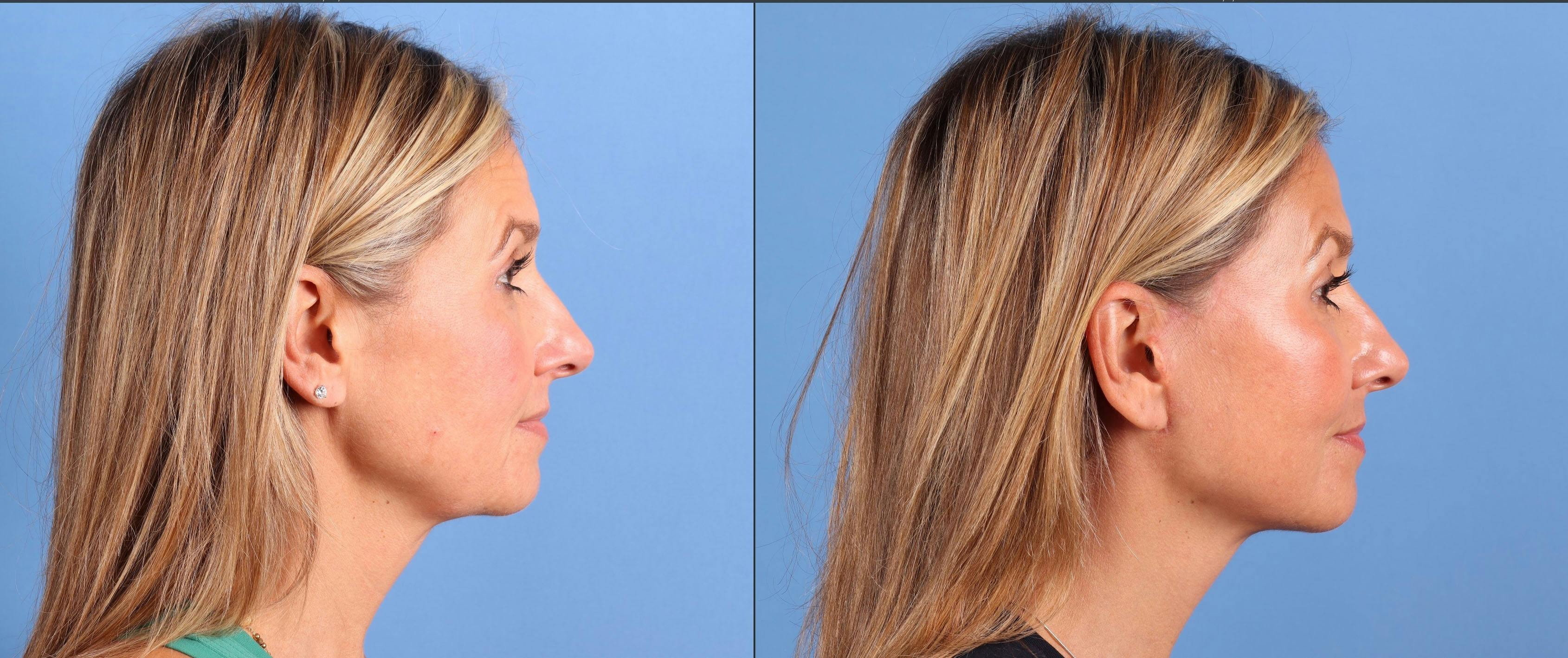 Facial Fillers Before & After Gallery - Patient 386281 - Image 3