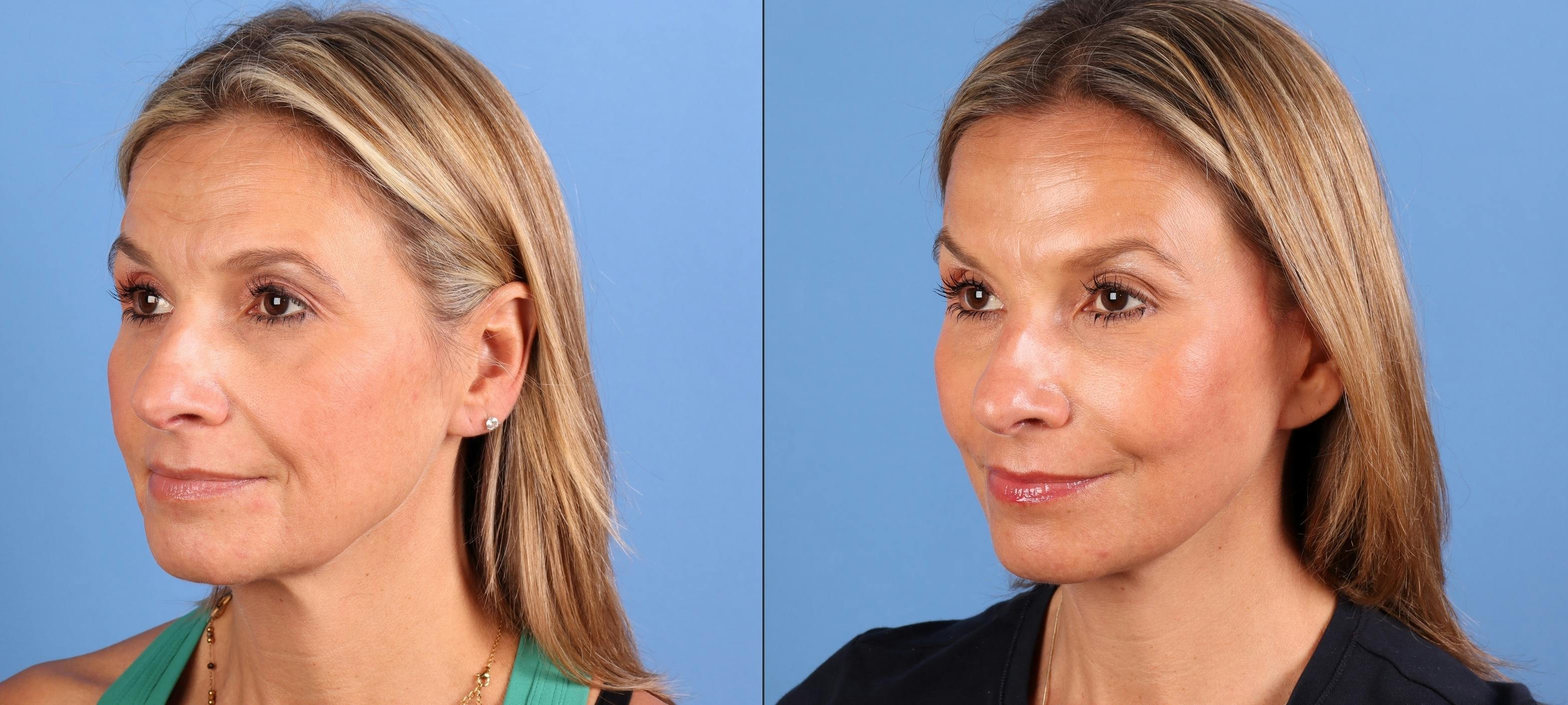 Facial Fillers Before & After Gallery - Patient 386281 - Image 4
