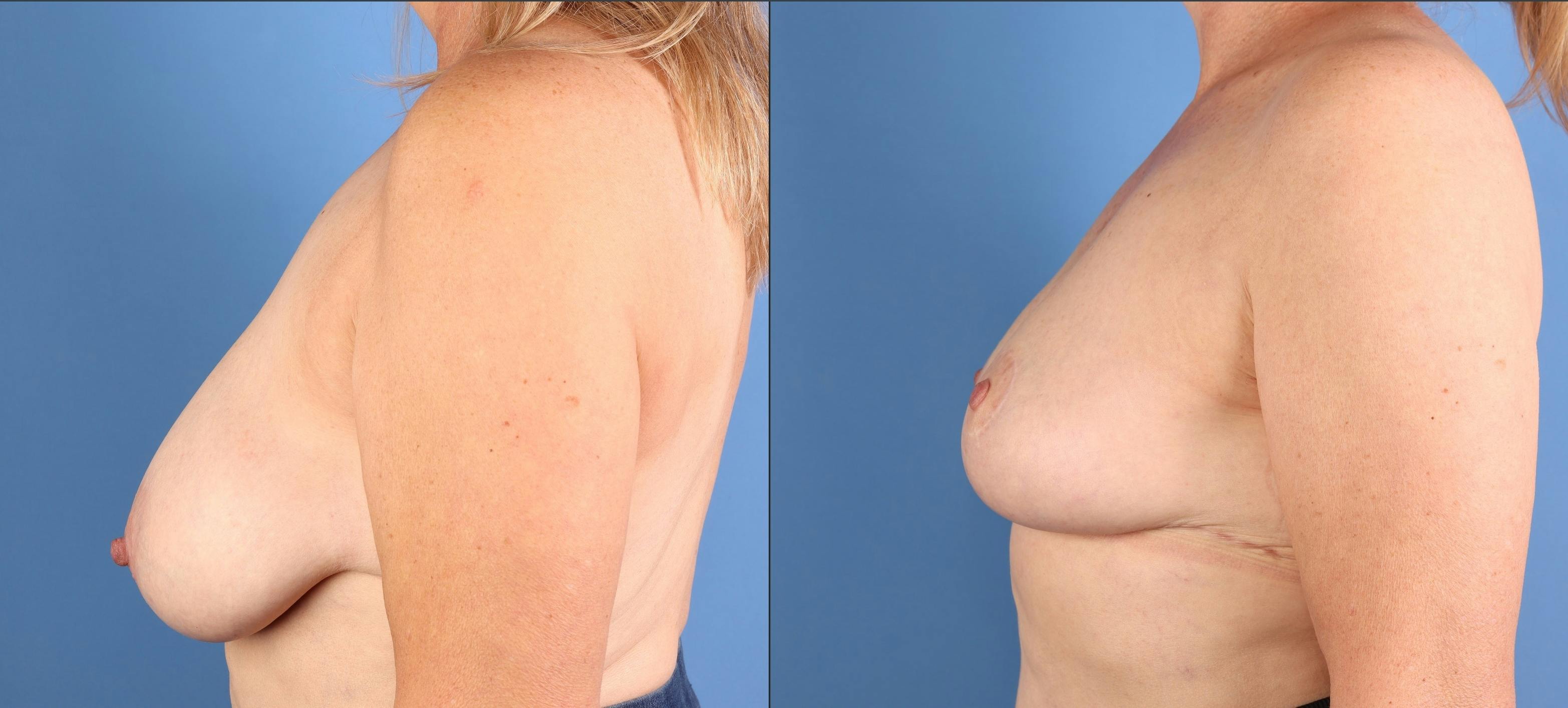 Breast Reduction Before & After Gallery - Patient 157007 - Image 5