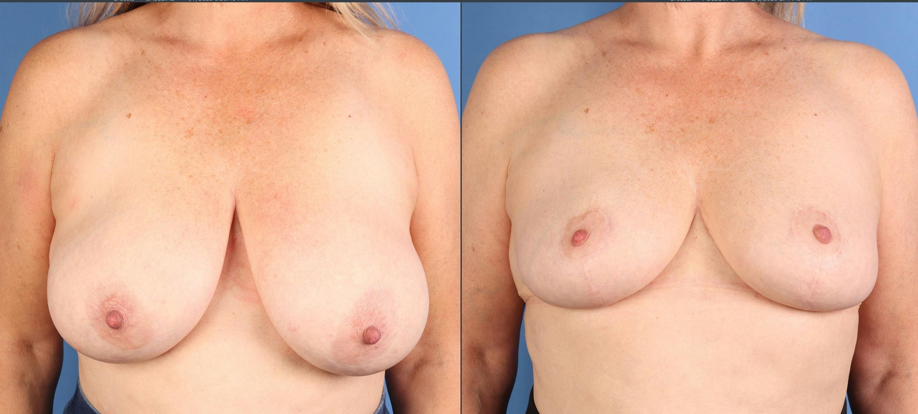 Breast Reduction Before & After Gallery - Patient 157007 - Image 1