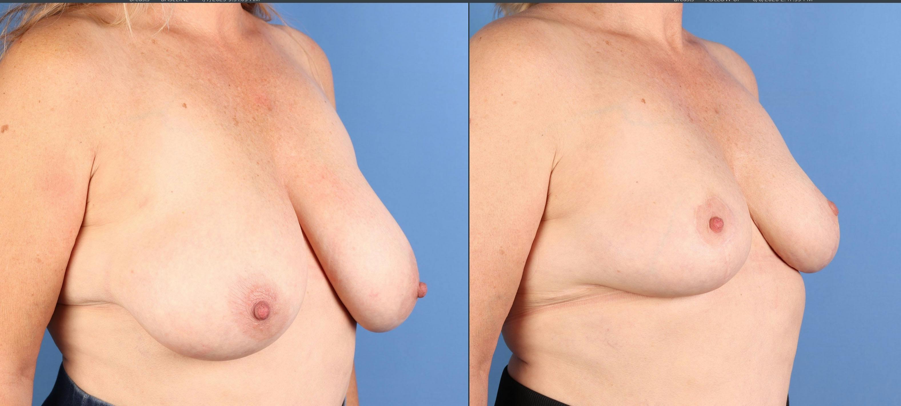Breast Reduction Before & After Gallery - Patient 157007 - Image 2