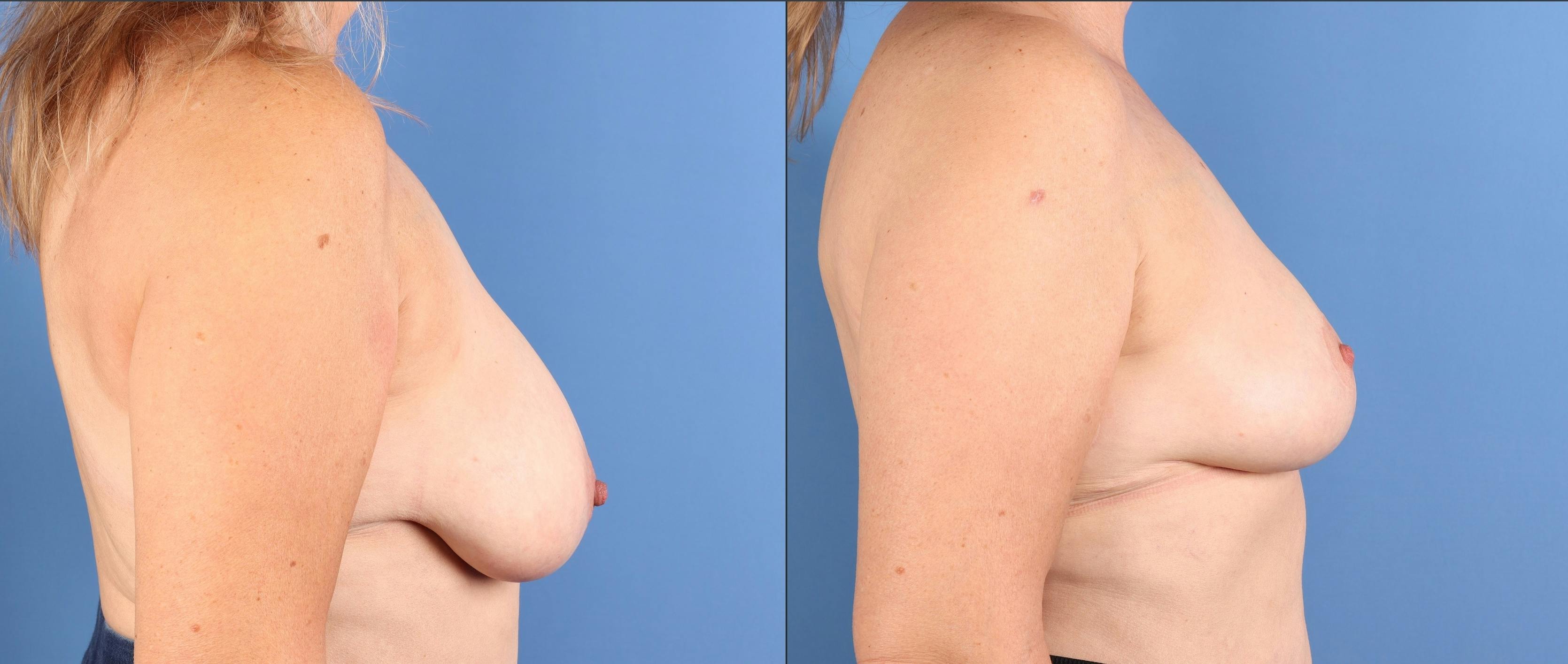 Breast Reduction Before & After Gallery - Patient 157007 - Image 3