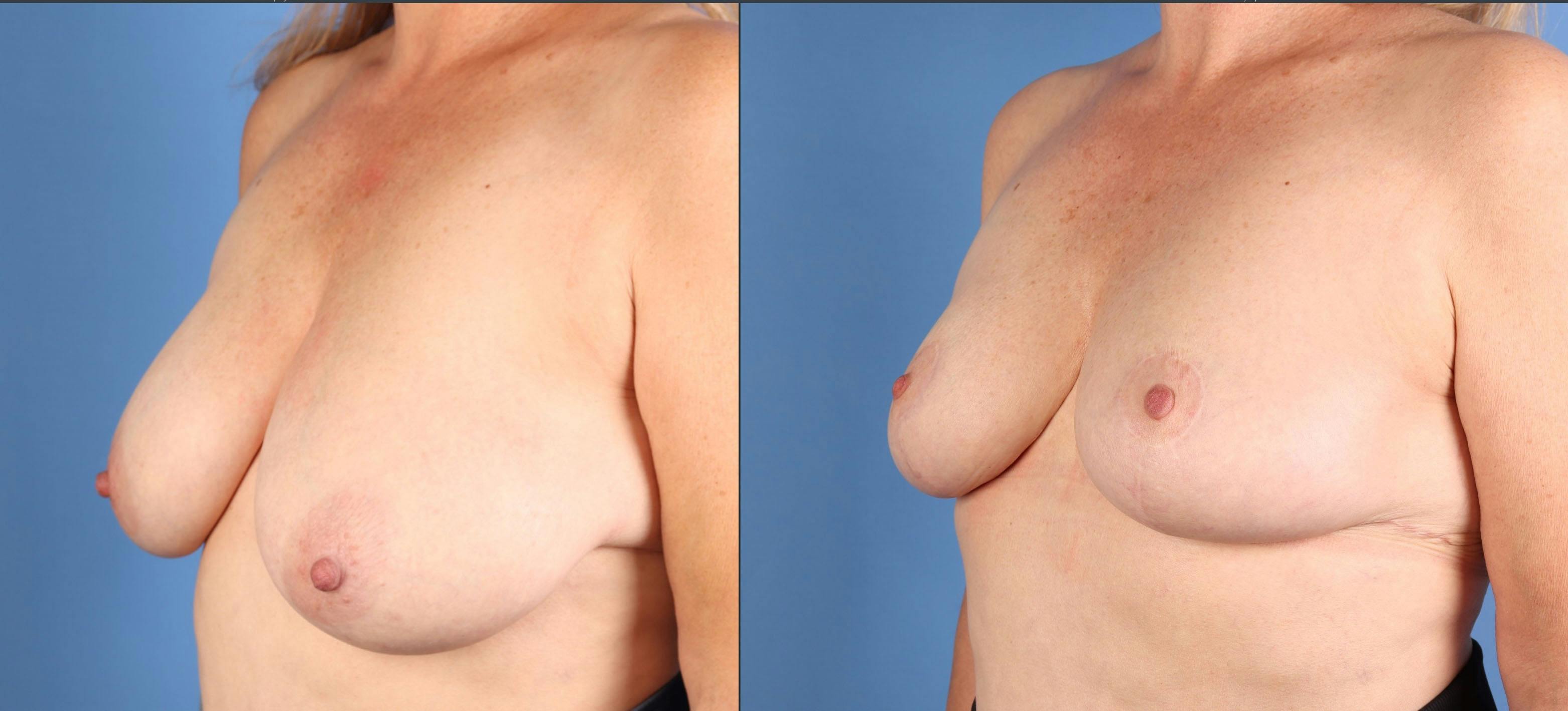Breast Reduction Before & After Gallery - Patient 157007 - Image 4