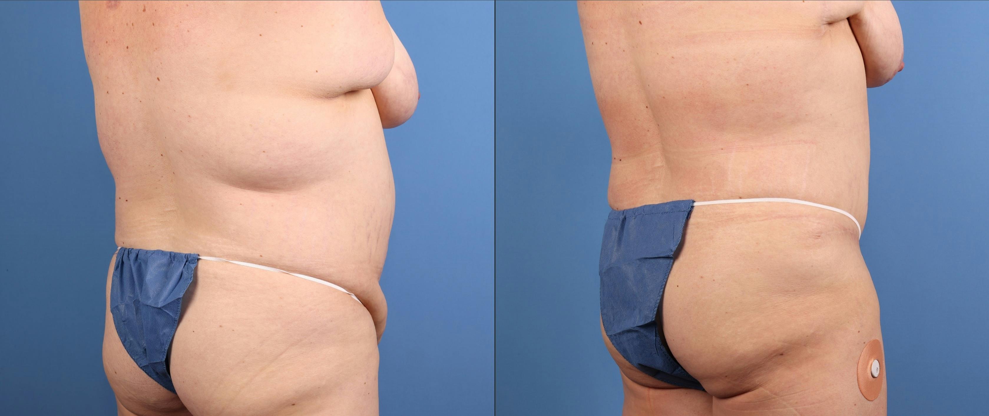 Tummy Tuck Before & After Gallery - Patient 269425 - Image 3