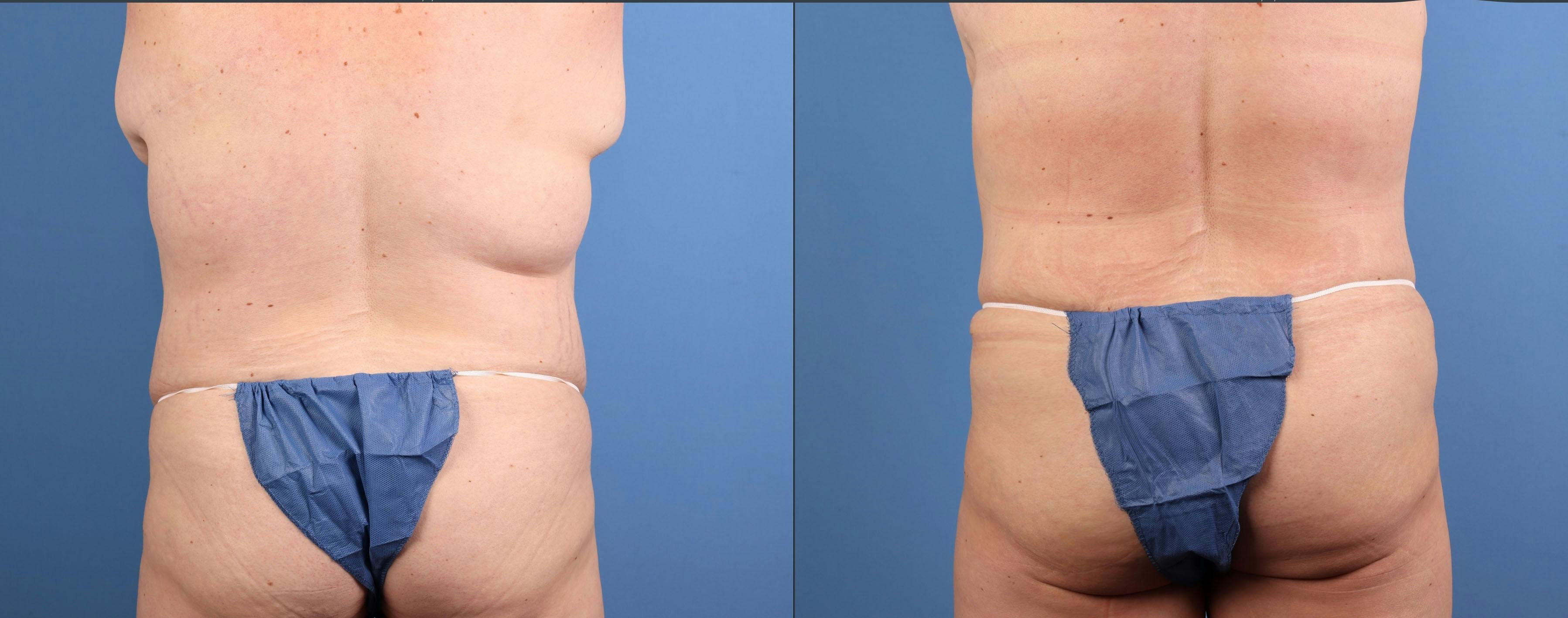 Tummy Tuck Before & After Gallery - Patient 269425 - Image 4