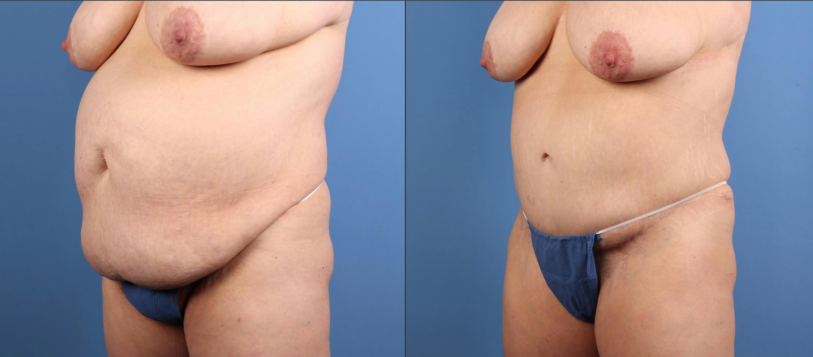 Tummy Tuck Before & After Gallery - Patient 269425 - Image 2