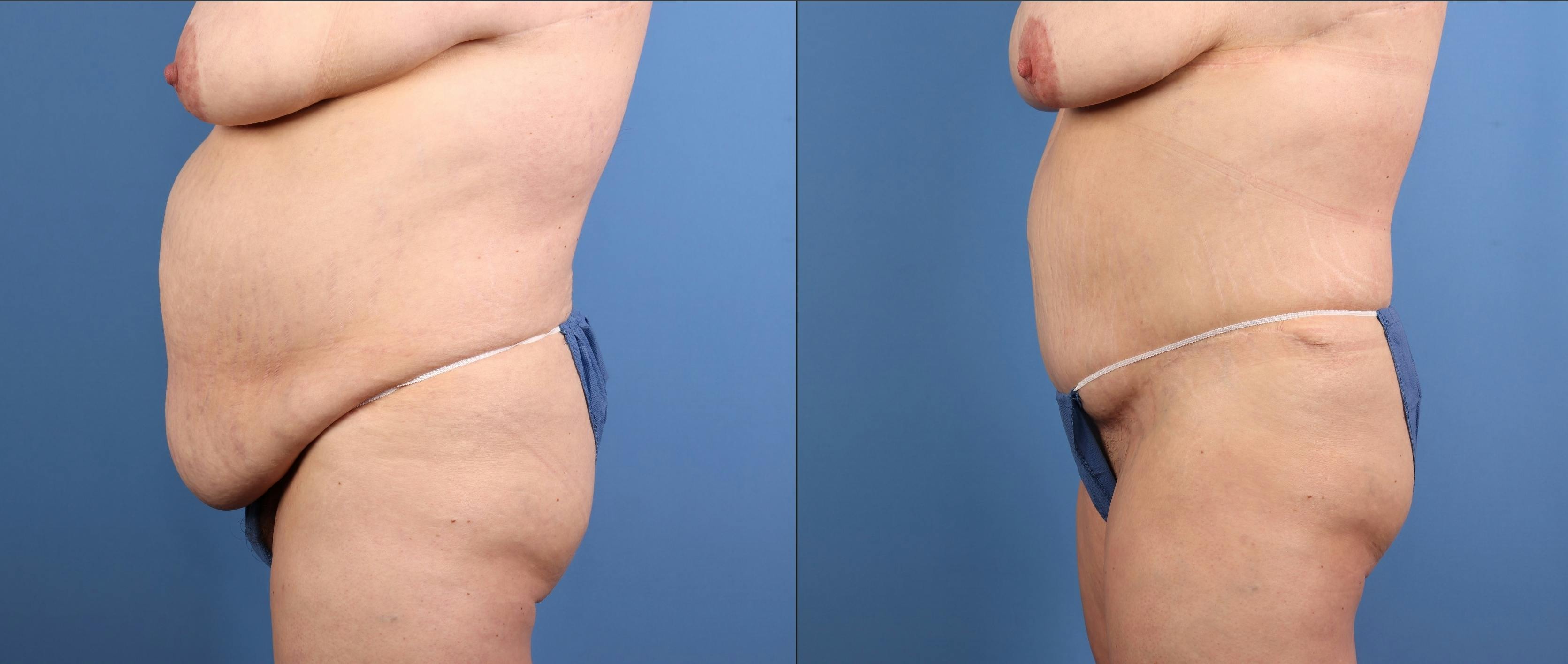 Tummy Tuck Before & After Gallery - Patient 269425 - Image 5