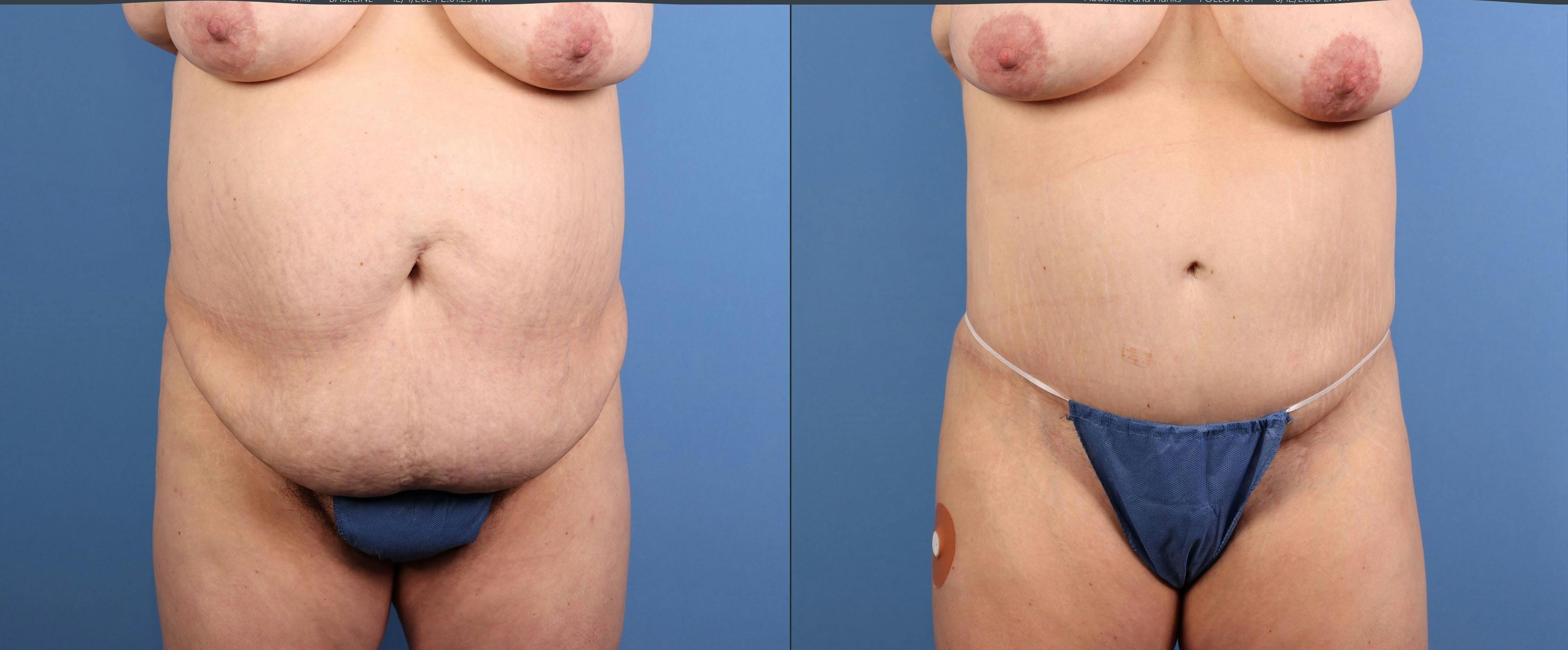 Tummy Tuck Before & After Gallery - Patient 269425 - Image 1