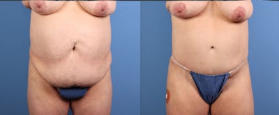 Tummy Tuck Before & After Gallery - Patient 269425 - Image 1