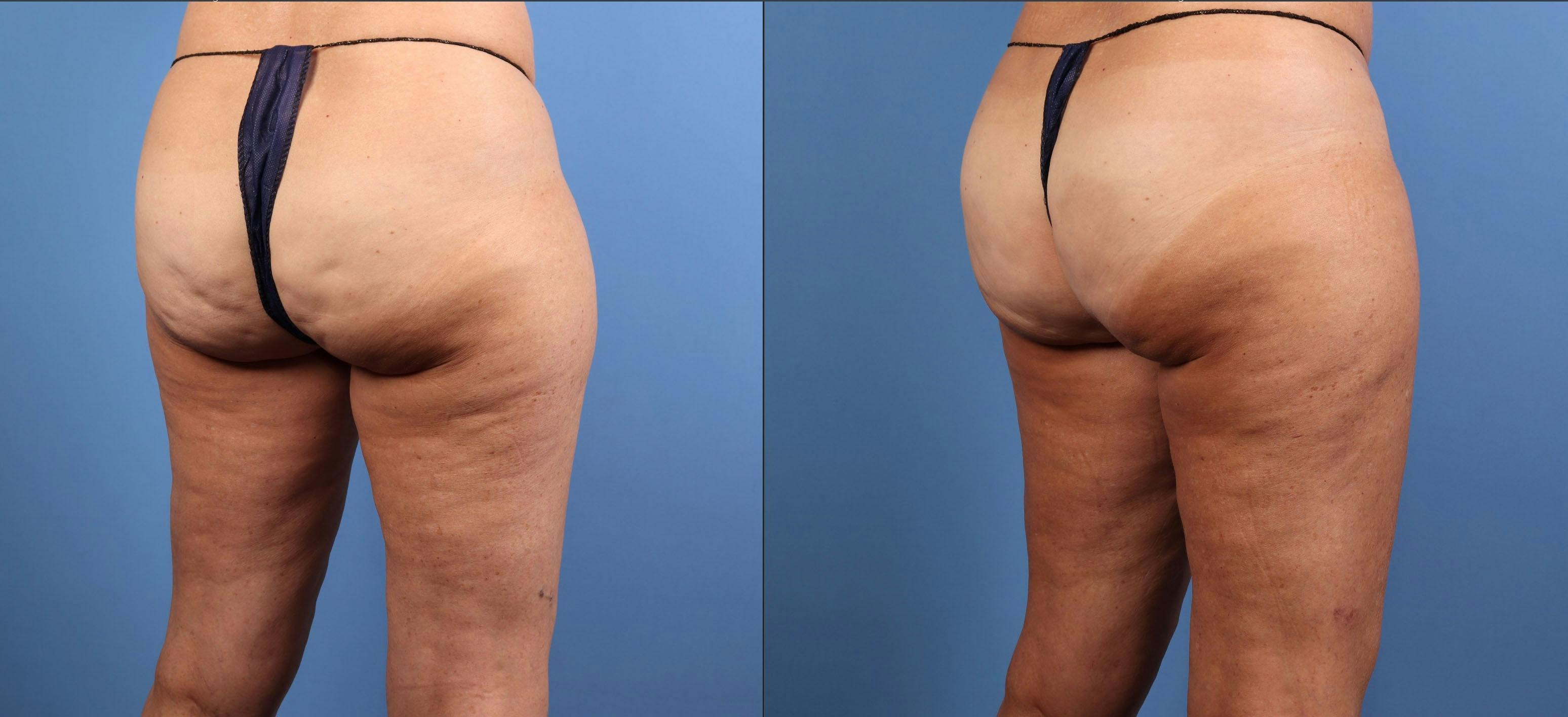 Cellulite Treatment Before & After Gallery - Patient 251541 - Image 2
