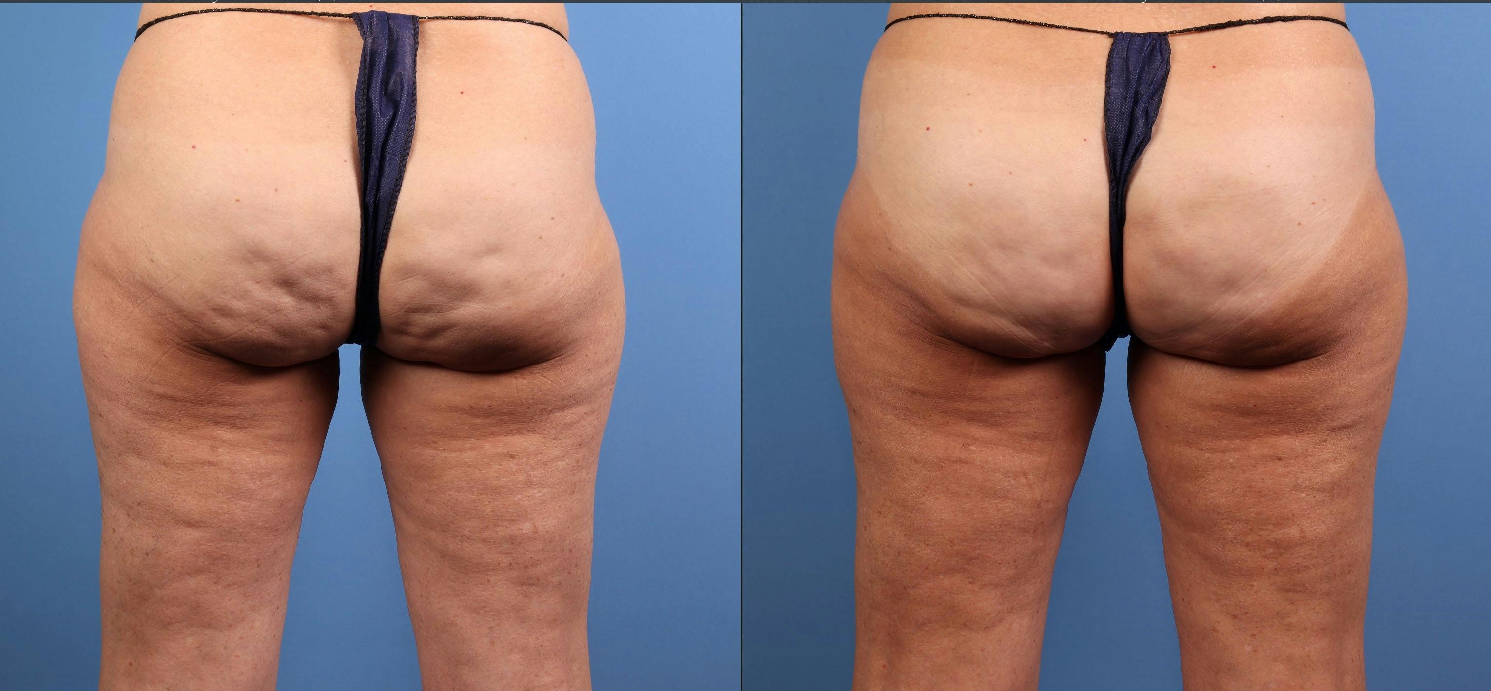 Cellulite Treatment Before & After Gallery - Patient 251541 - Image 1