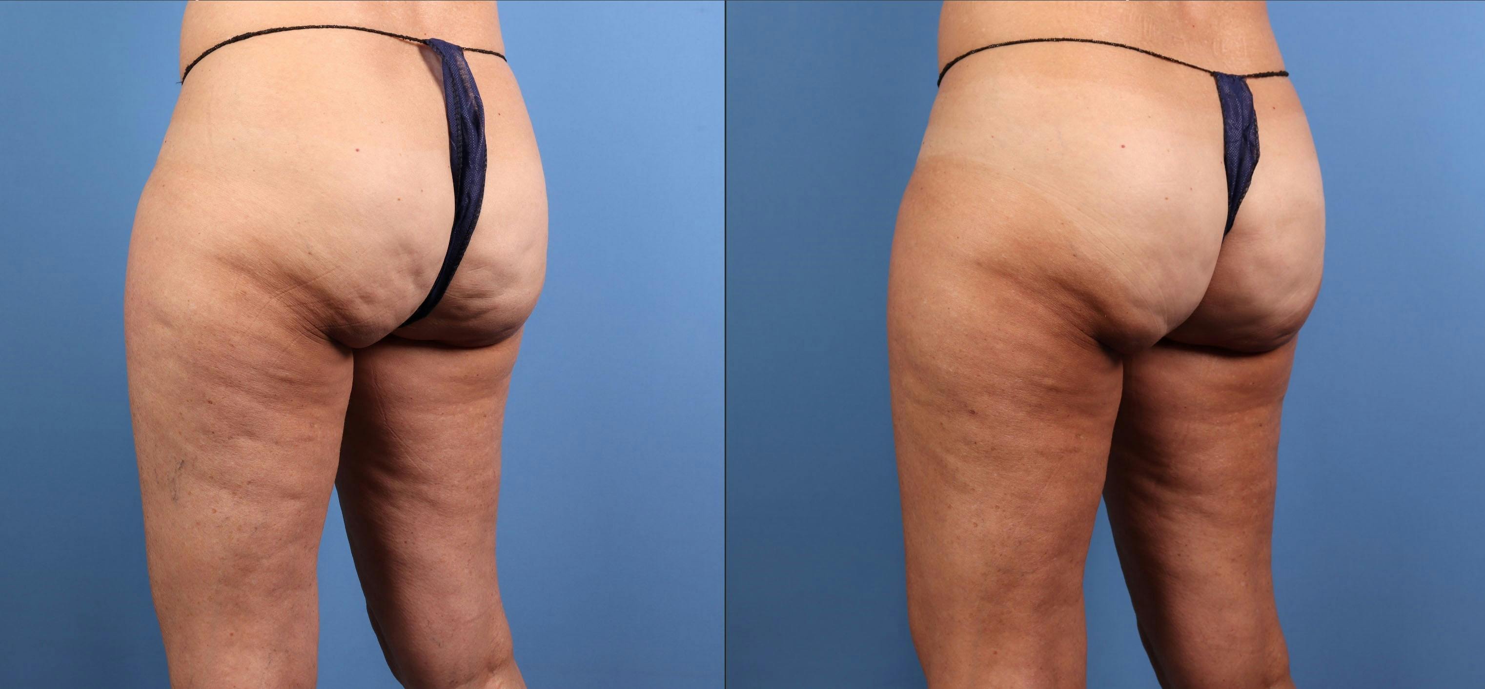 Cellulite Treatment Before & After Gallery - Patient 251541 - Image 3