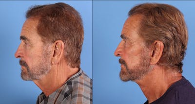 Neck Lift Before & After Gallery - Patient 629737 - Image 1