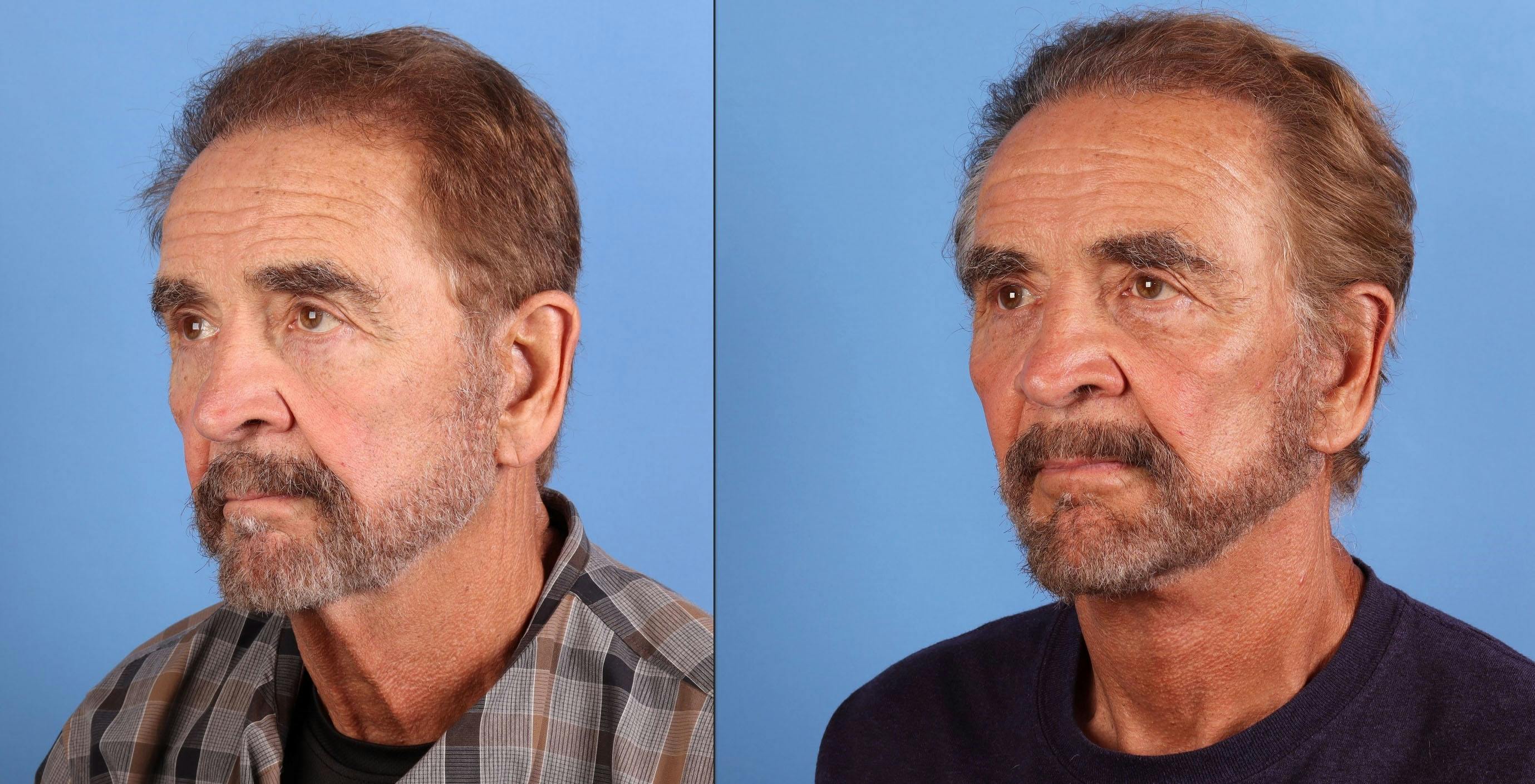 Face Lift Before & After Gallery - Patient 226050 - Image 4