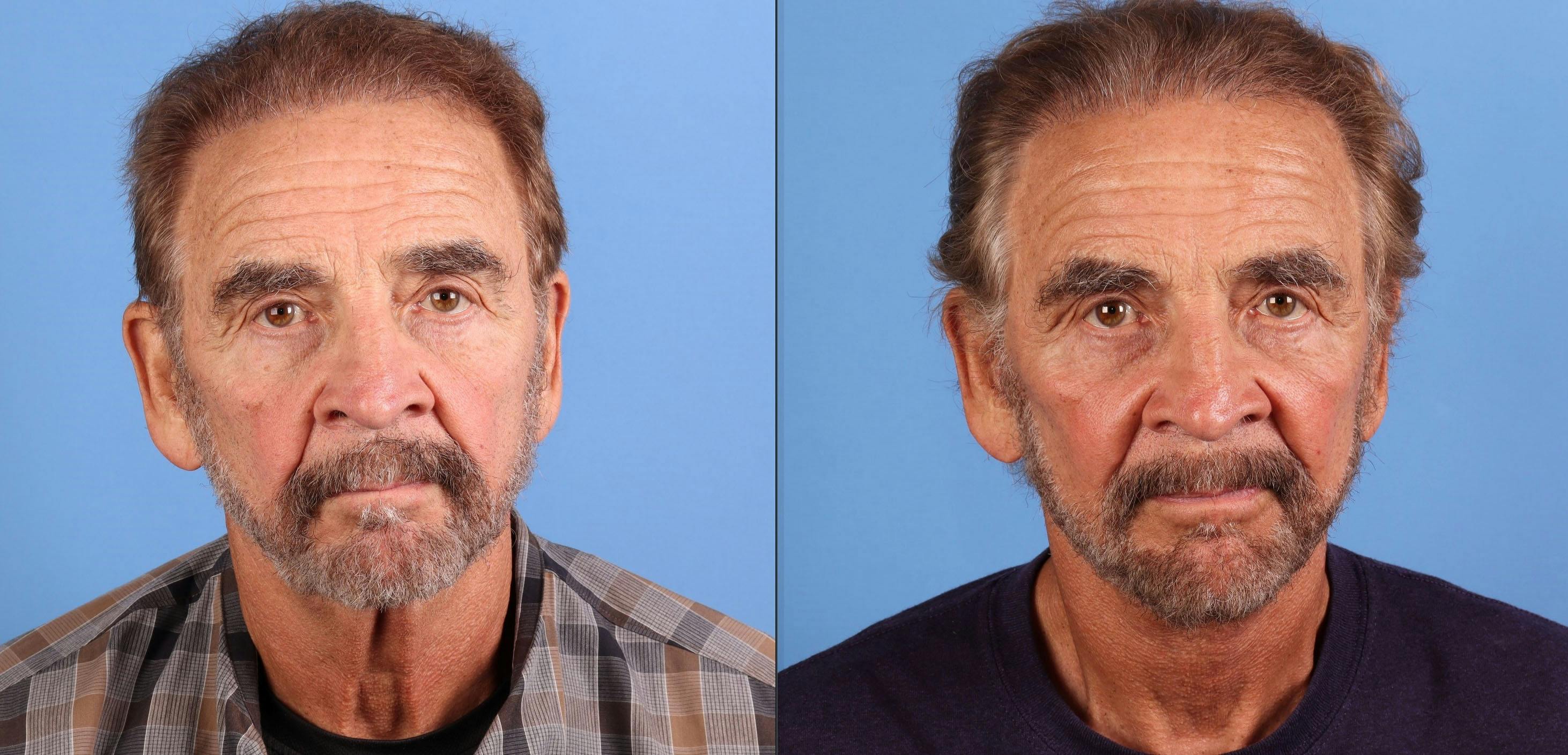 Face Lift Before & After Gallery - Patient 226050 - Image 1