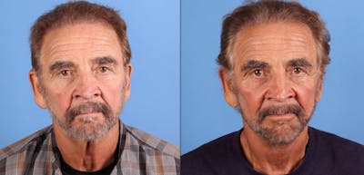 Laser Treatments Before & After Gallery - Patient 374657 - Image 1