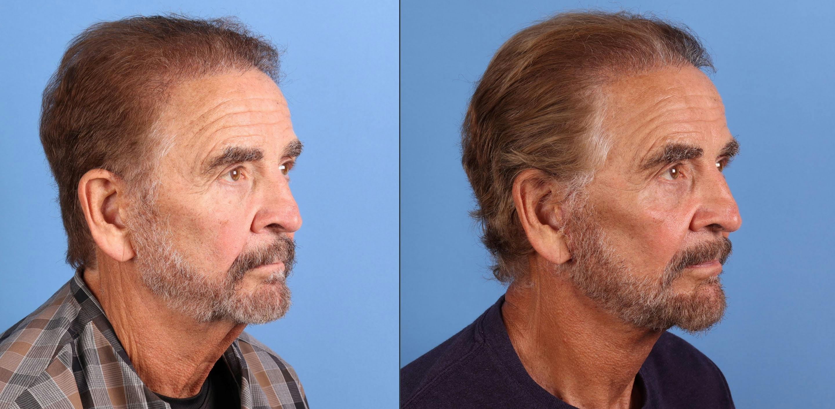 Face Lift Before & After Gallery - Patient 226050 - Image 2