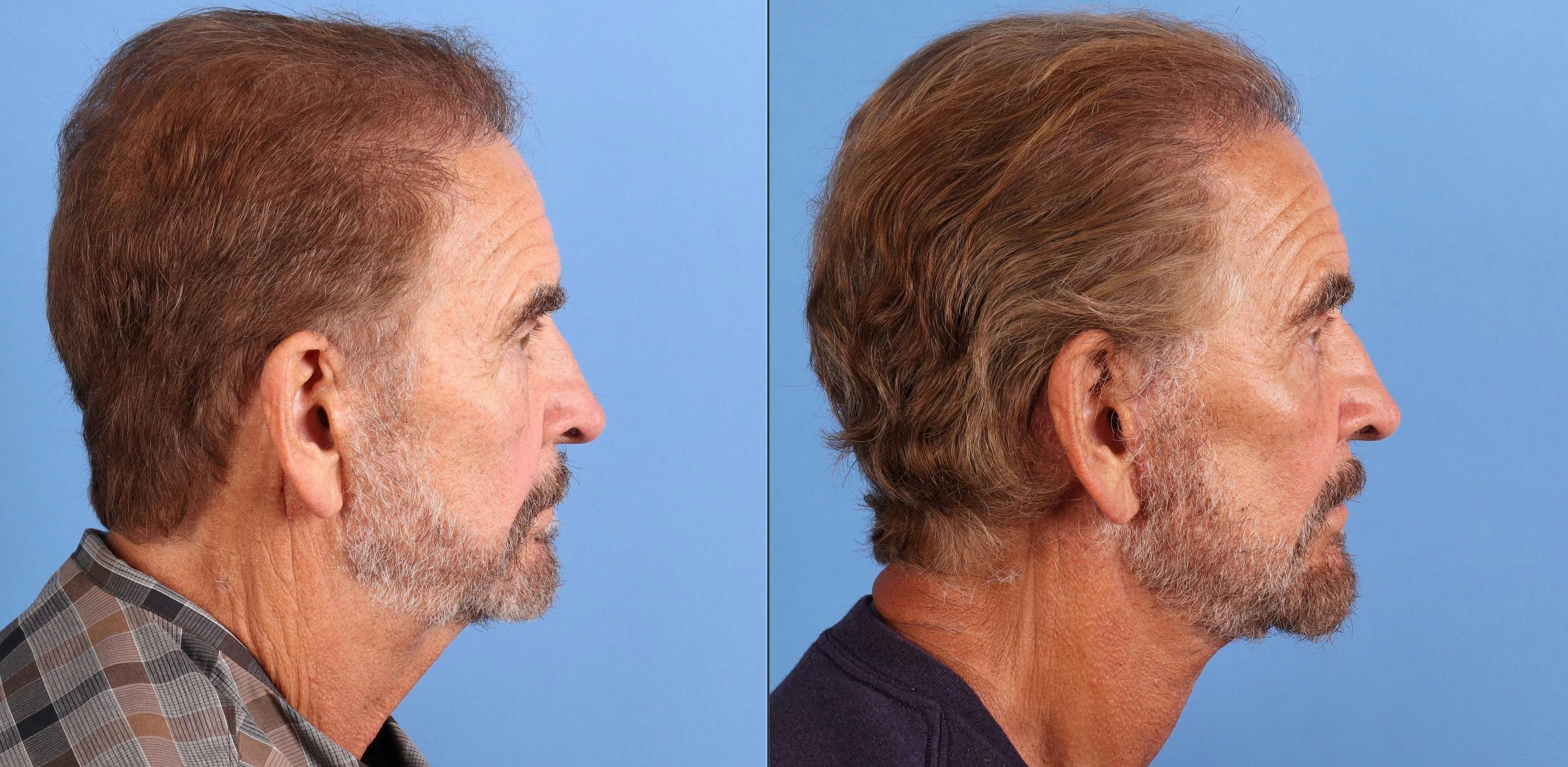 Face Lift Before & After Gallery - Patient 226050 - Image 3