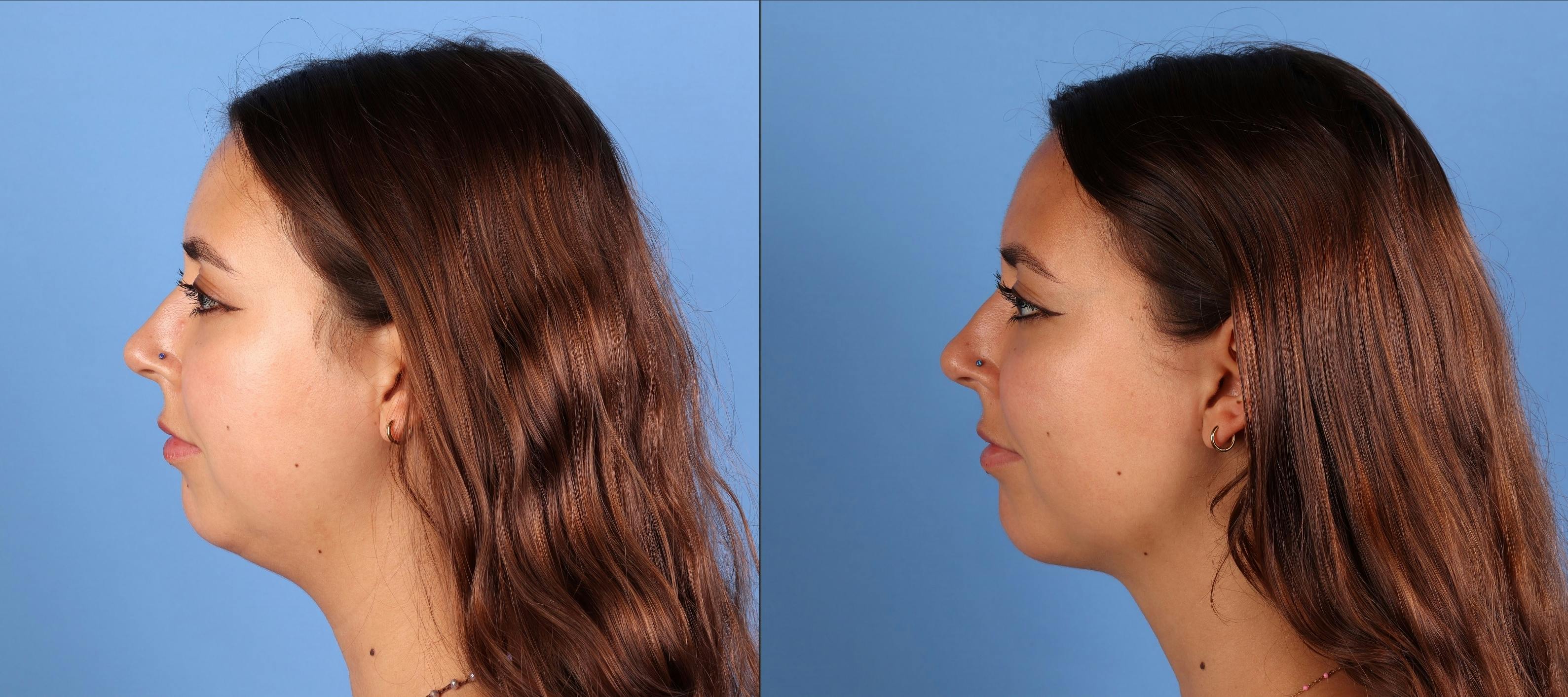 Facial Fillers Before & After Gallery - Patient 177649 - Image 4