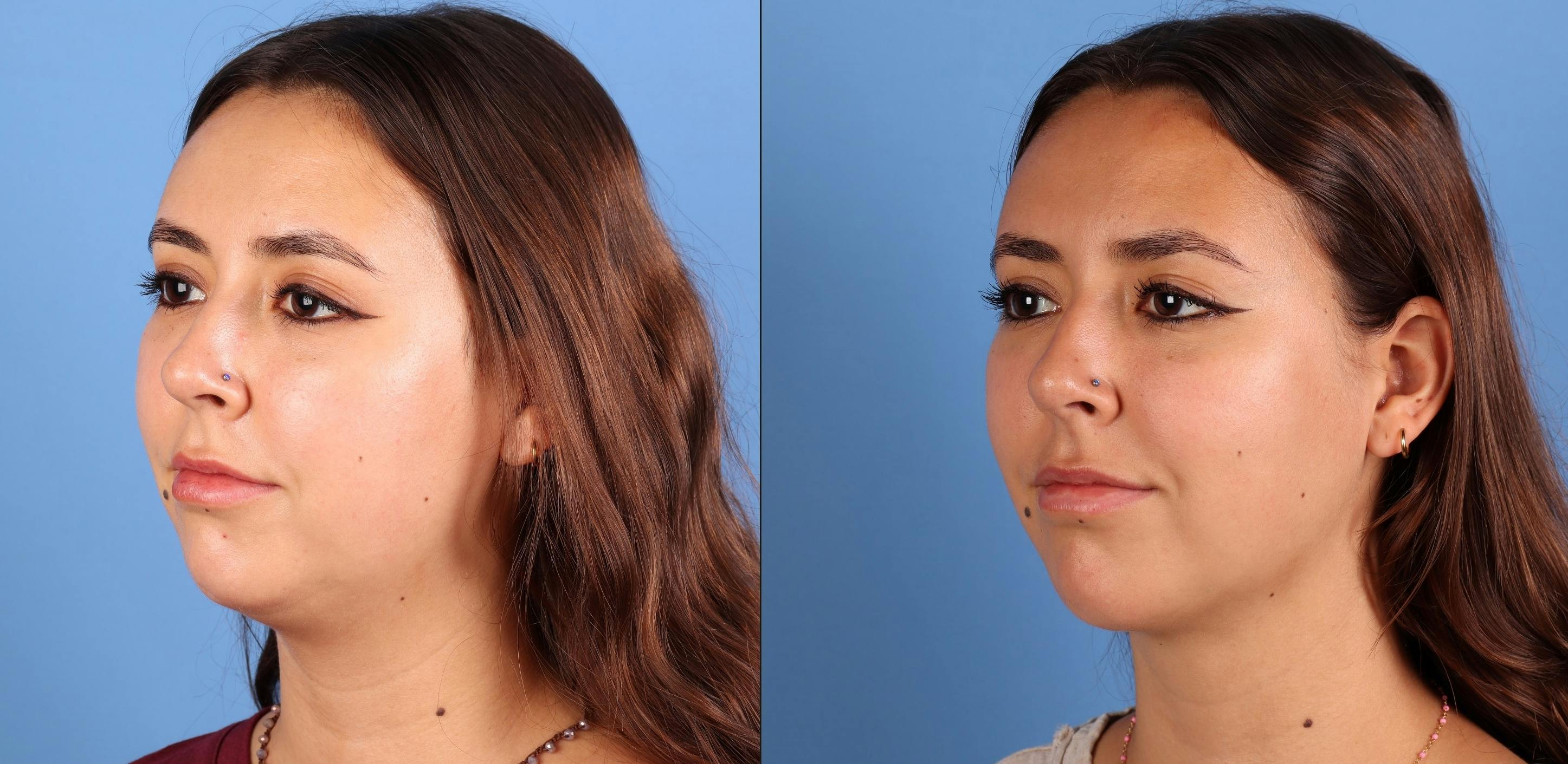 Facial Fillers Before & After Gallery - Patient 177649 - Image 2