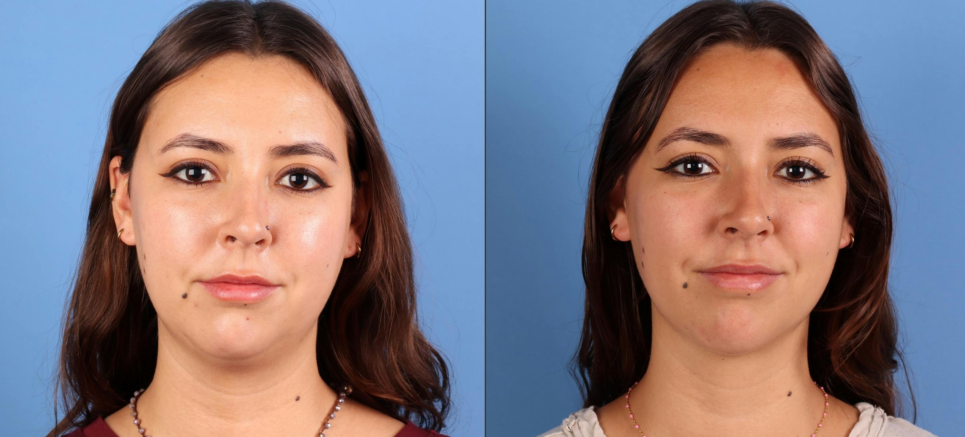 Facial Fillers Before & After Gallery - Patient 177649 - Image 1
