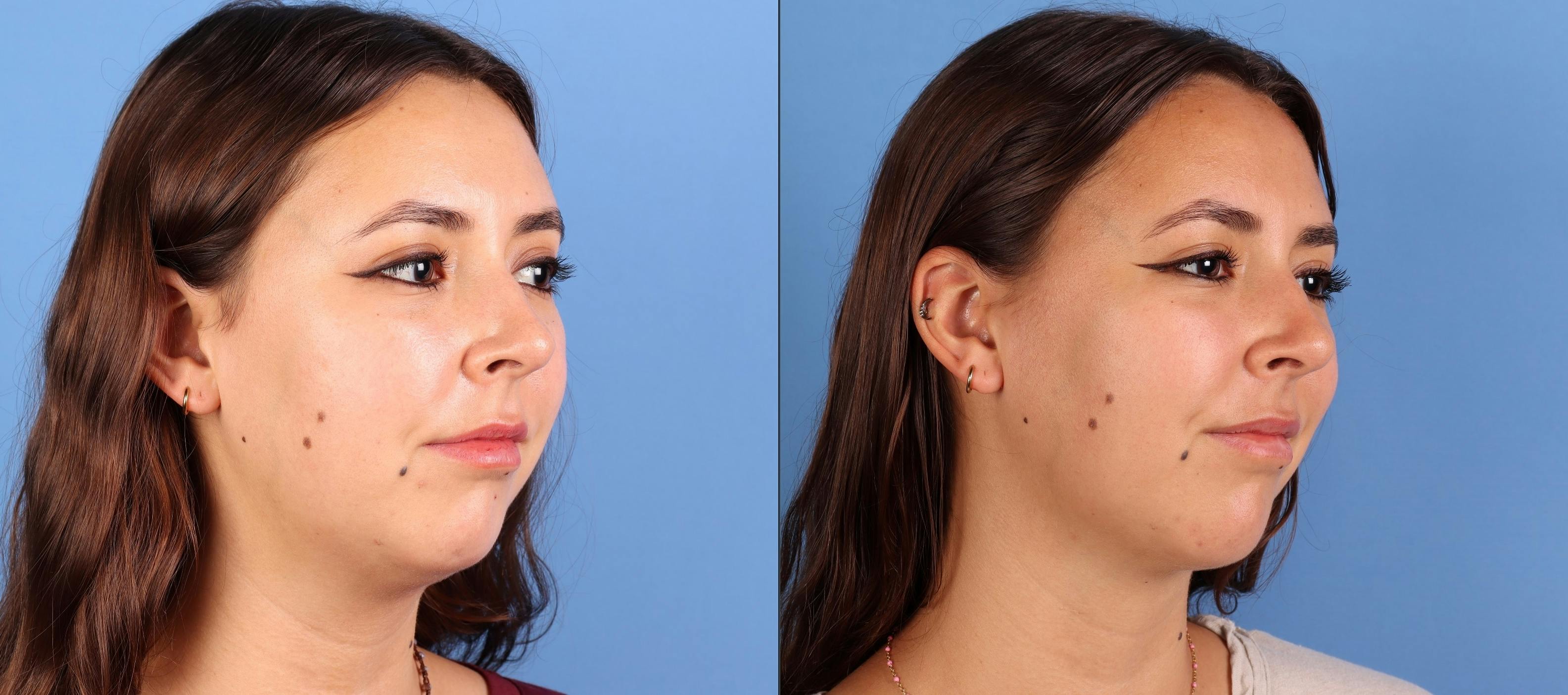 Facial Fillers Before & After Gallery - Patient 177649 - Image 3