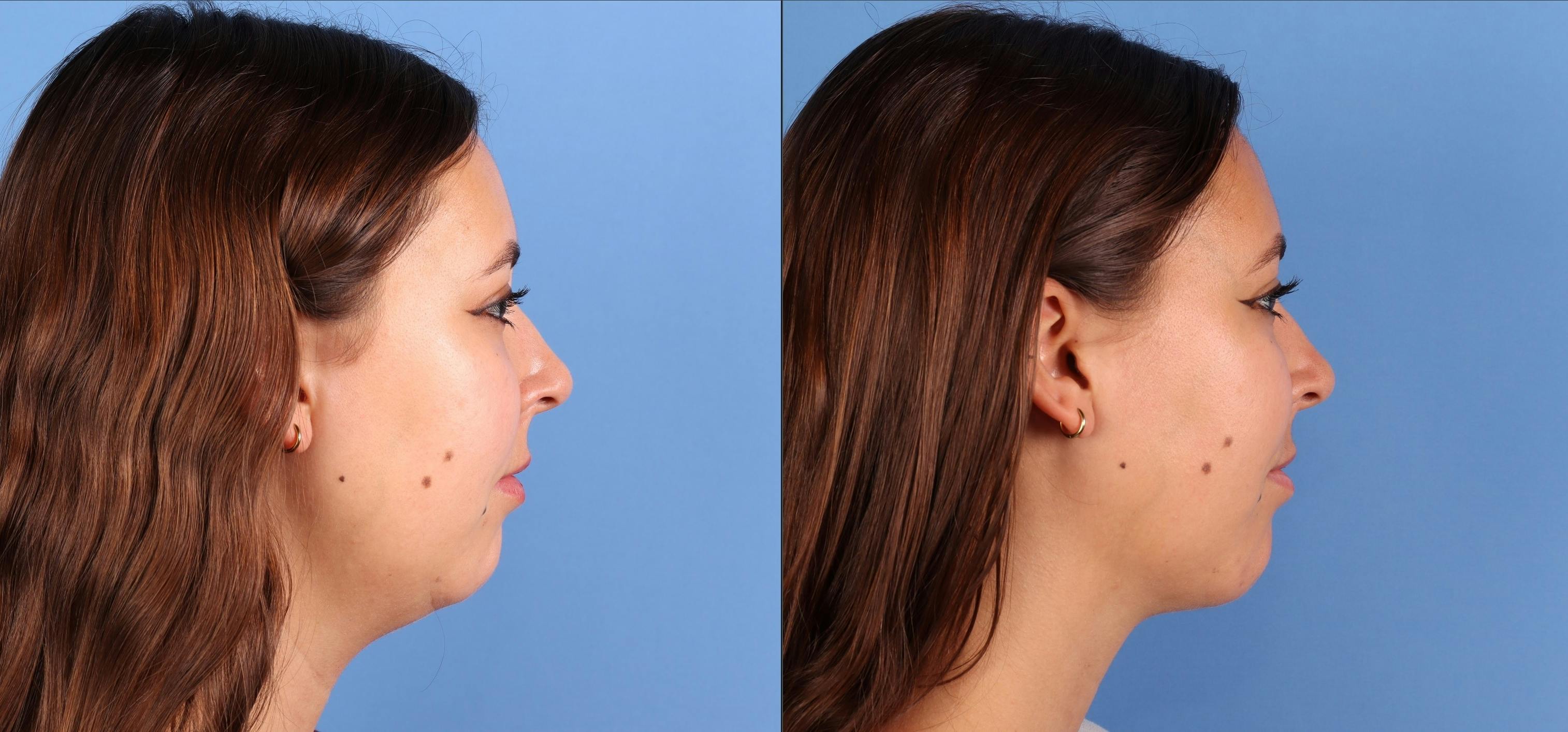 Facial Fillers Before & After Gallery - Patient 177649 - Image 5