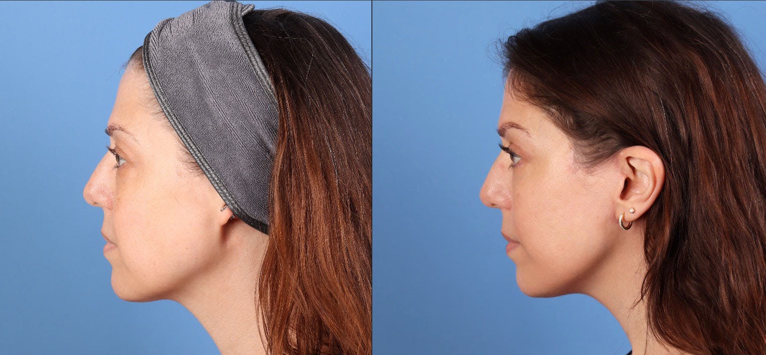 Eyelid Surgery (Upper & Lower Blepharoplasty) Before & After Gallery - Patient 308806 - Image 4