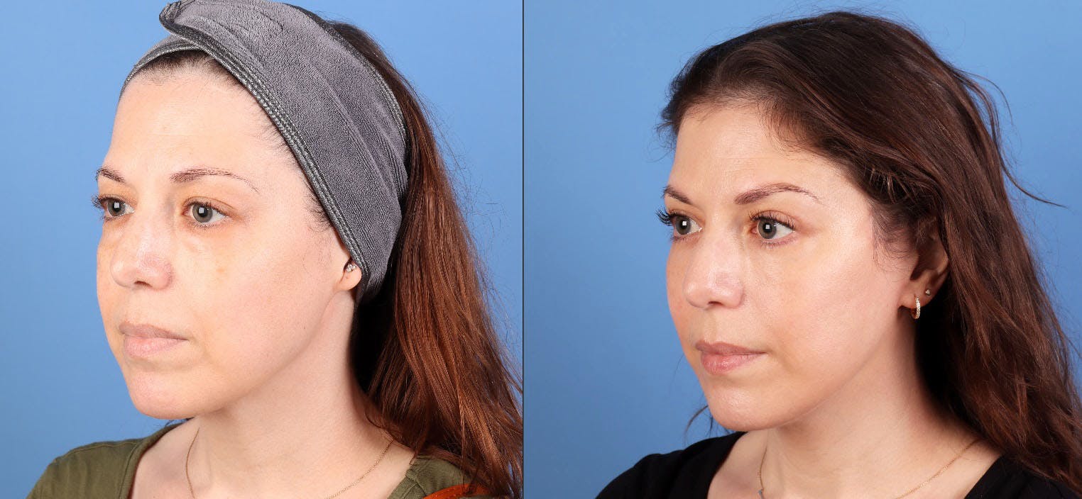 Eyelid Surgery (Upper & Lower Blepharoplasty) Before & After Gallery - Patient 308806 - Image 3