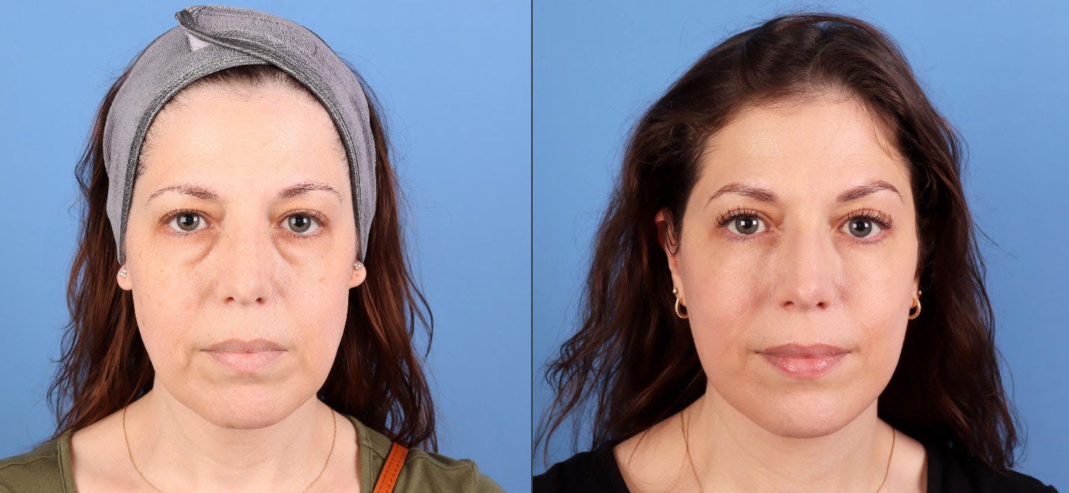 Eyelid Surgery (Upper & Lower Blepharoplasty) Before & After Gallery - Patient 308806 - Image 1