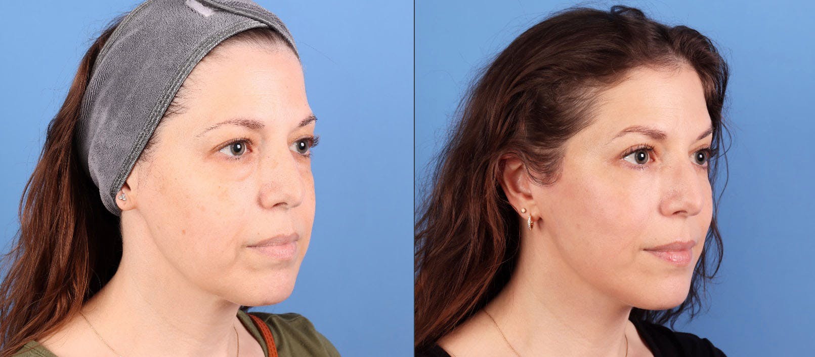 Eyelid Surgery (Upper & Lower Blepharoplasty) Before & After Gallery - Patient 308806 - Image 2