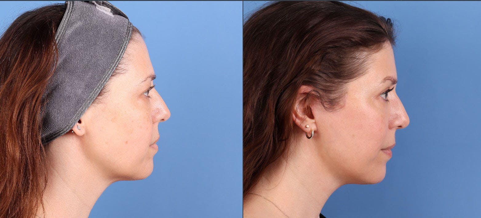 Eyelid Surgery (Upper & Lower Blepharoplasty) Before & After Gallery - Patient 308806 - Image 5