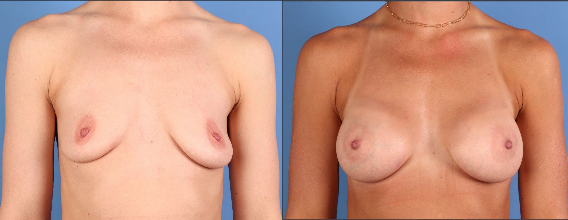 Breast Augmentation Before & After Gallery - Patient 114789 - Image 1