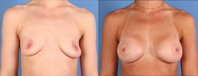 Breast Augmentation Before & After Gallery - Patient 114789 - Image 1