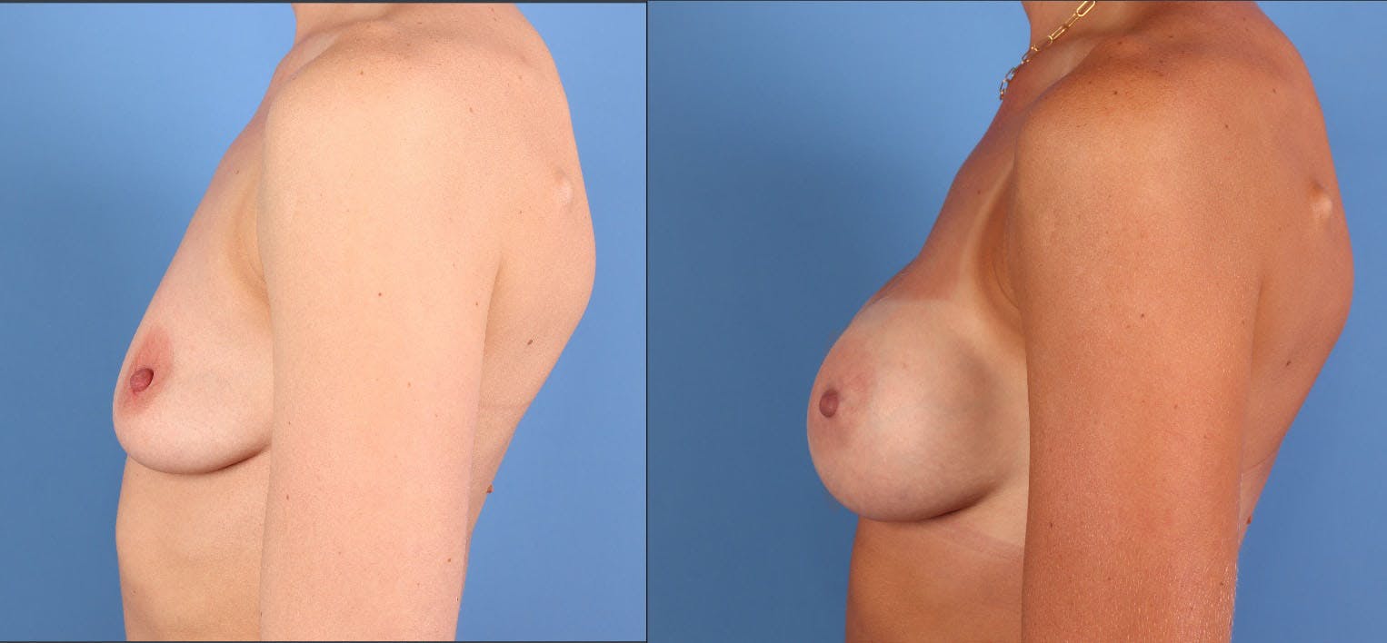 Breast Augmentation Before & After Gallery - Patient 114789 - Image 3