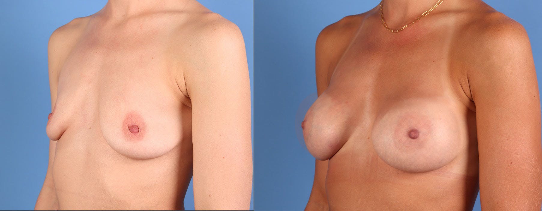 Breast Augmentation Before & After Gallery - Patient 114789 - Image 2
