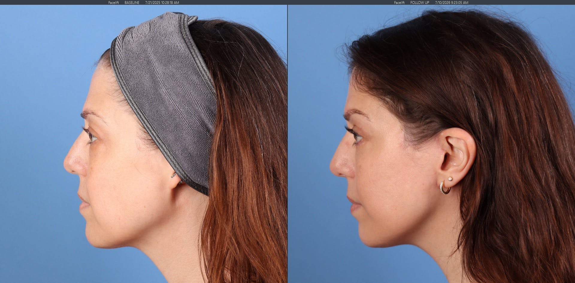 Eyelid Surgery (Upper & Lower Blepharoplasty) Before & After Gallery - Patient 308806 - Image 4